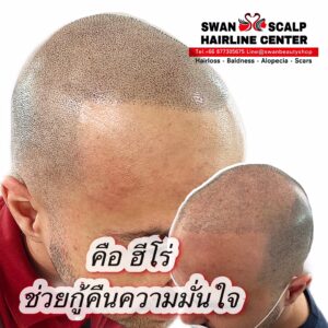 คืนความมั่นใจด้วยการสักทรงสกินเฮดH06